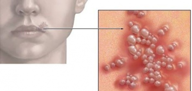 ceaiul-care-te-scapa-rapid-de-herpes-afla-cum-se-prepara-388250